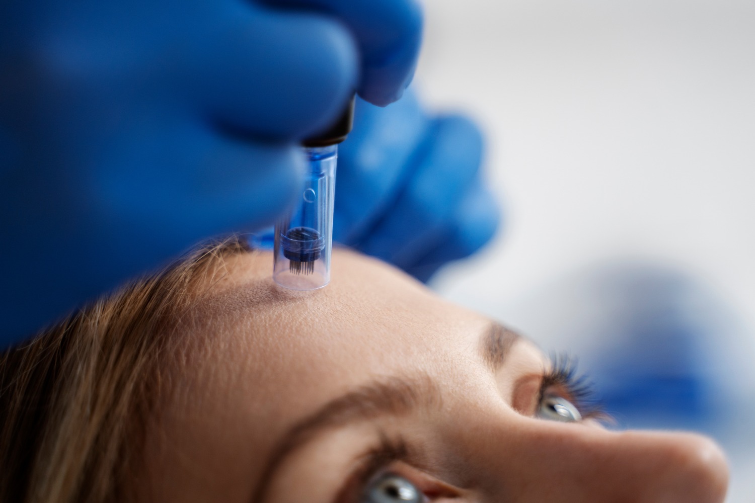 Microneedling for skin at Anoos