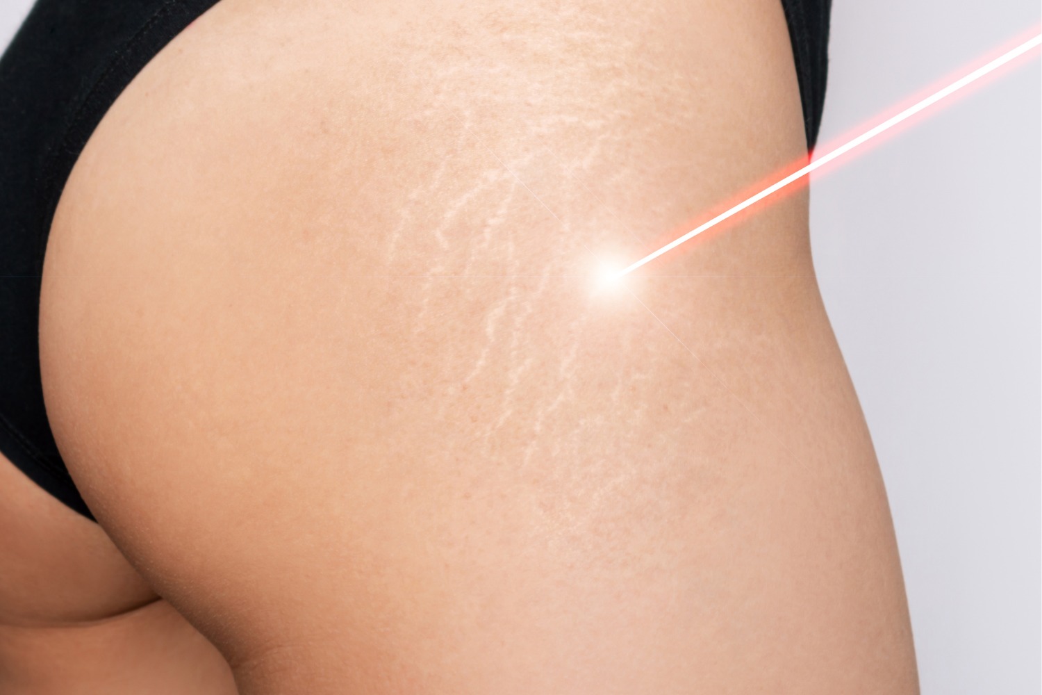 Microdermabrasion at Anoos