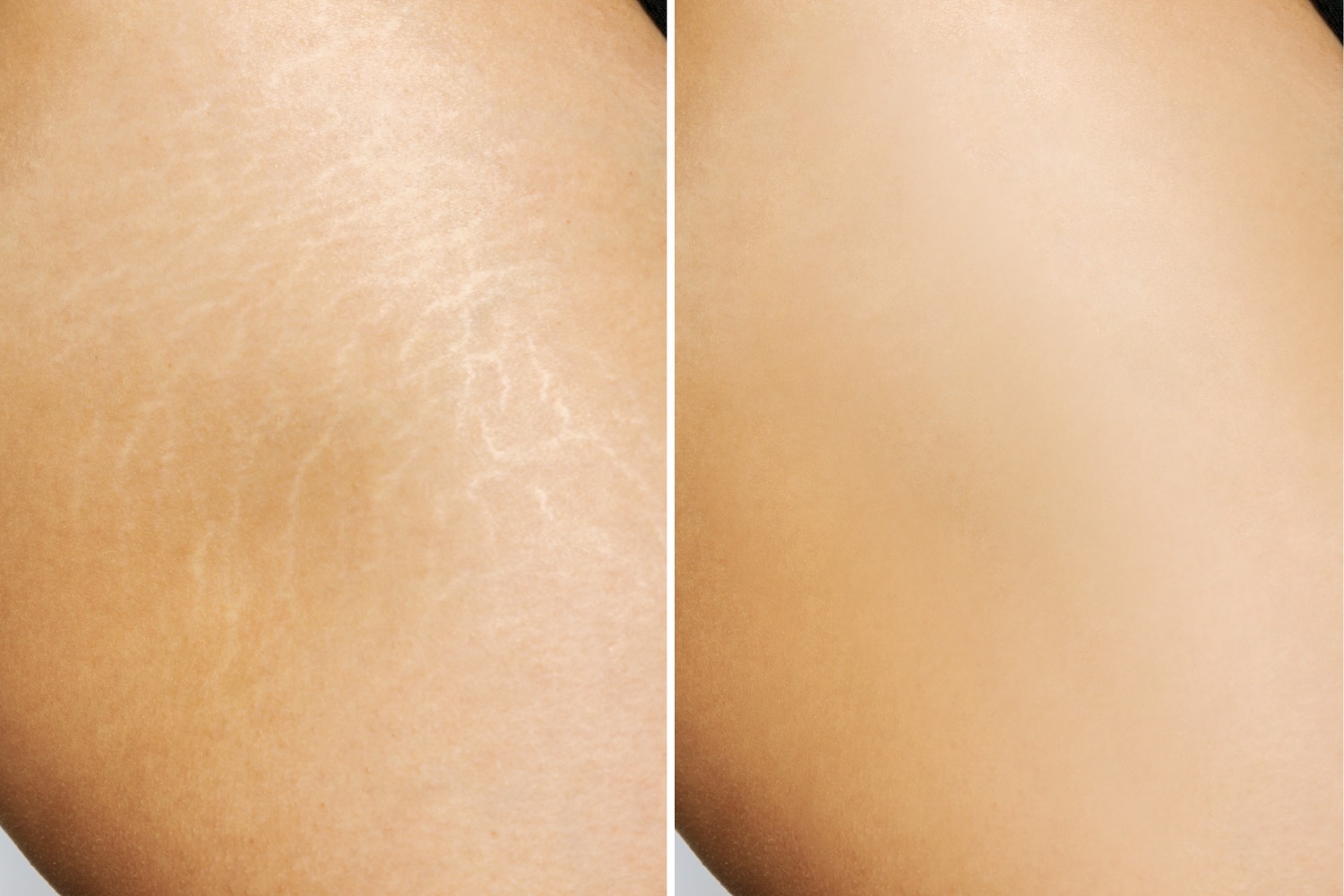 Chemical peels for stretch marks removal at Anoos