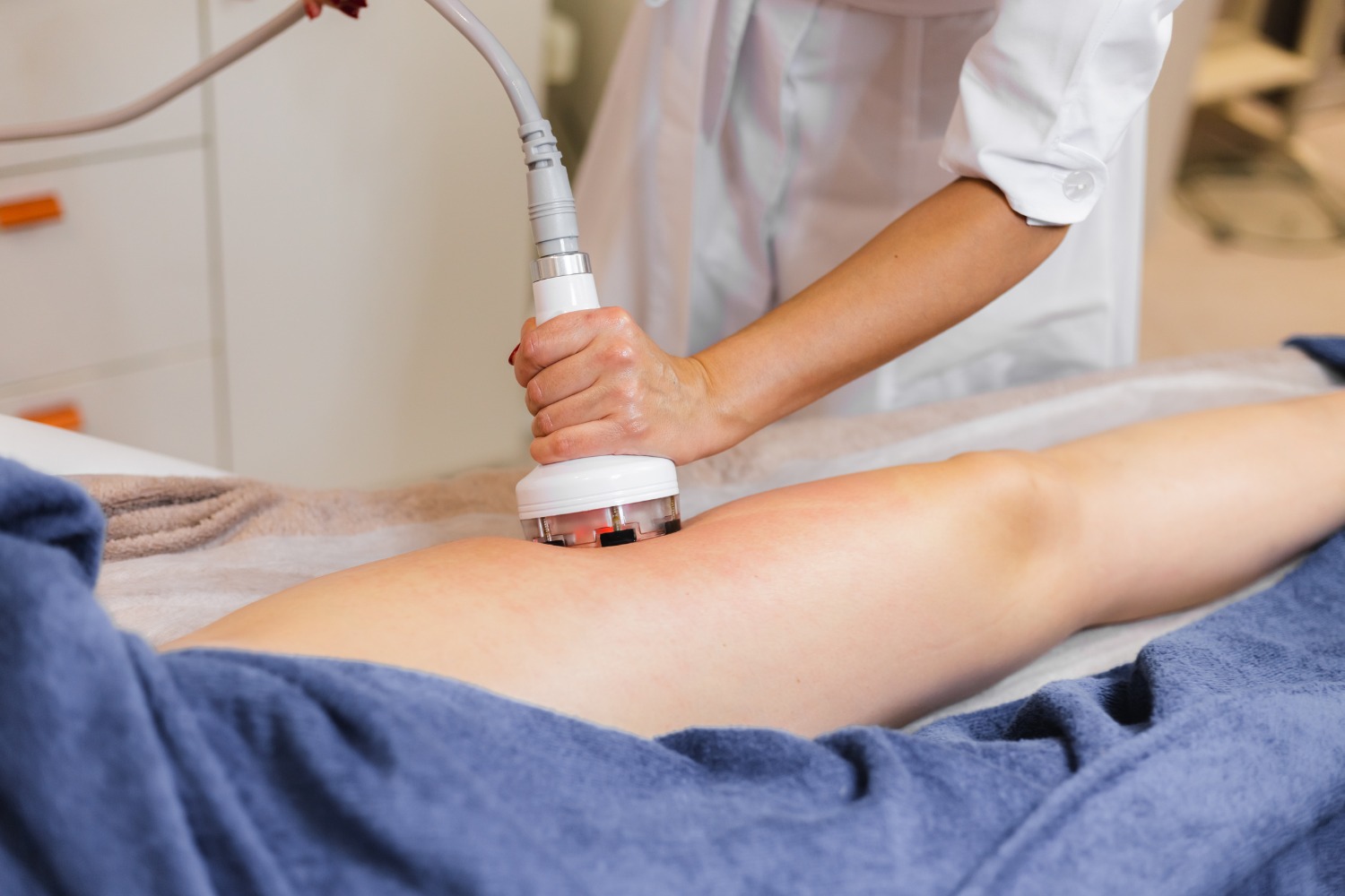 Laser Resurfacing for stretch marks removal