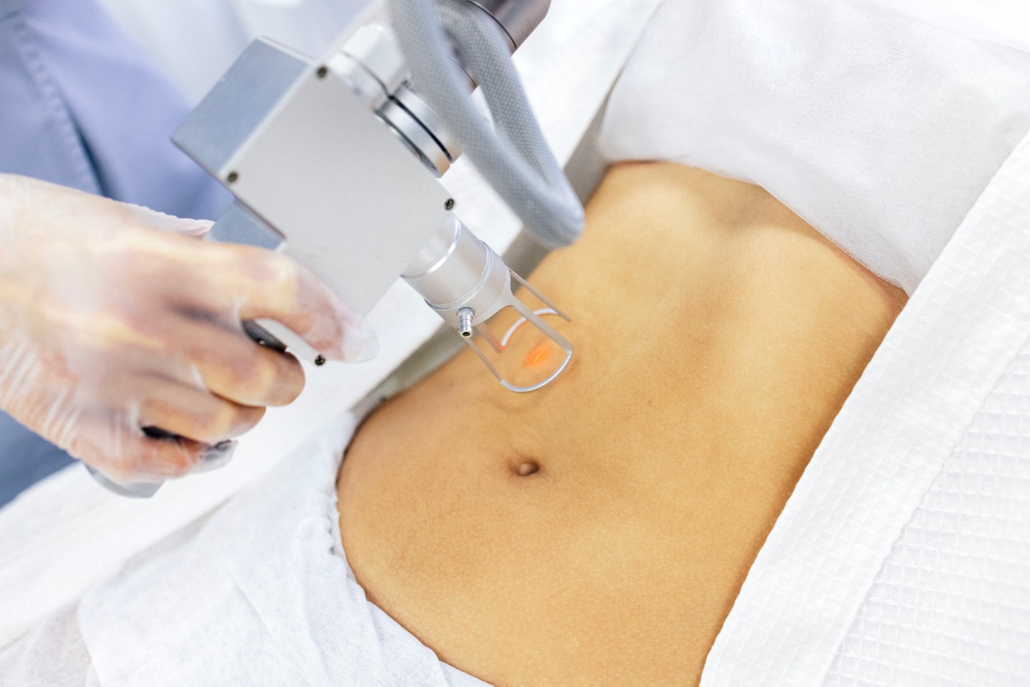CO2 Laser for stretch marks removal treatment at Anoos