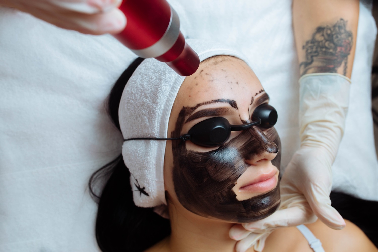 Q-Switch Laser for skin brightening at Anoos