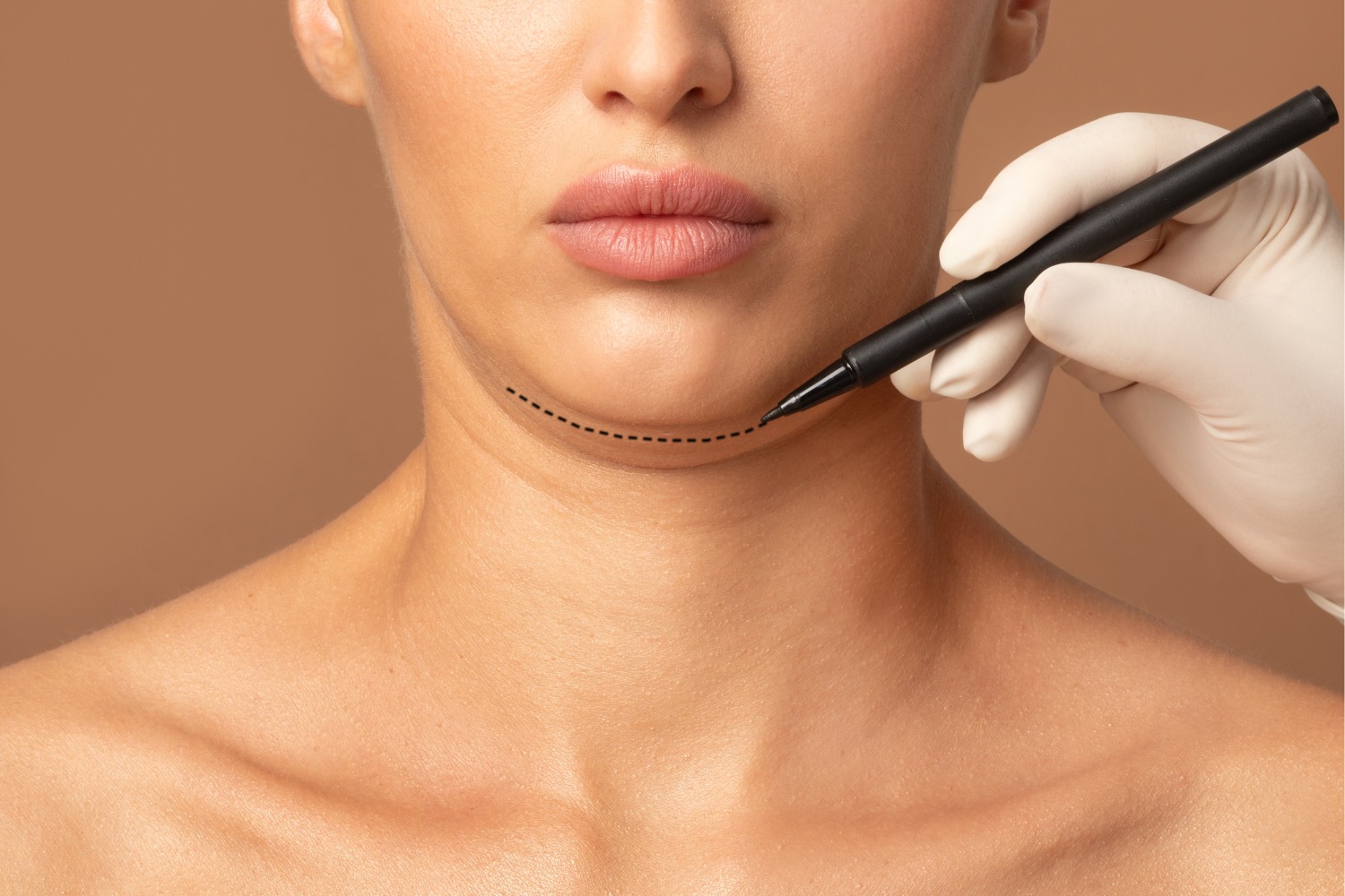Collagen Threads for sagging chin