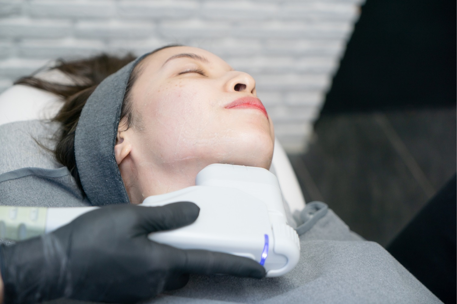 HIFU for Double Chin Reduction